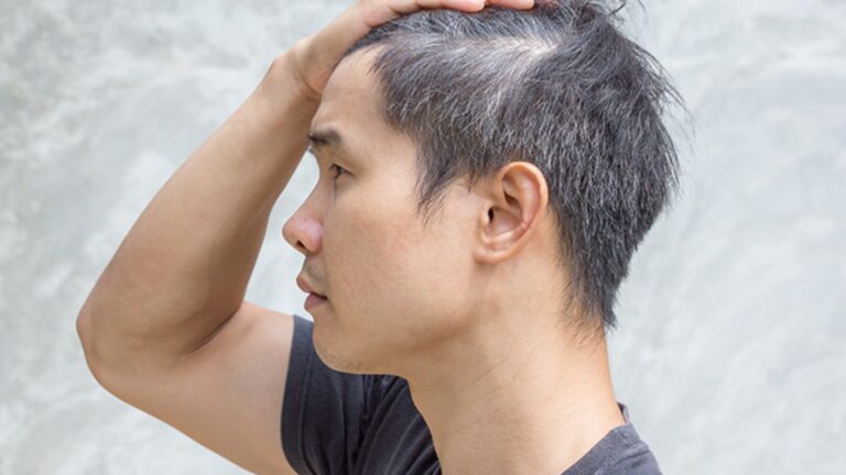 Uban Sebelum Waktunya? Ini Cara Menghambat dan Mencegahnya